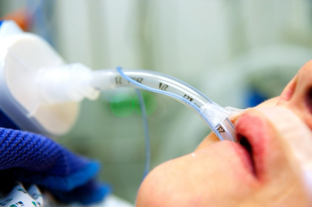 Survival Chances of Paralysis Patients on Ventilators